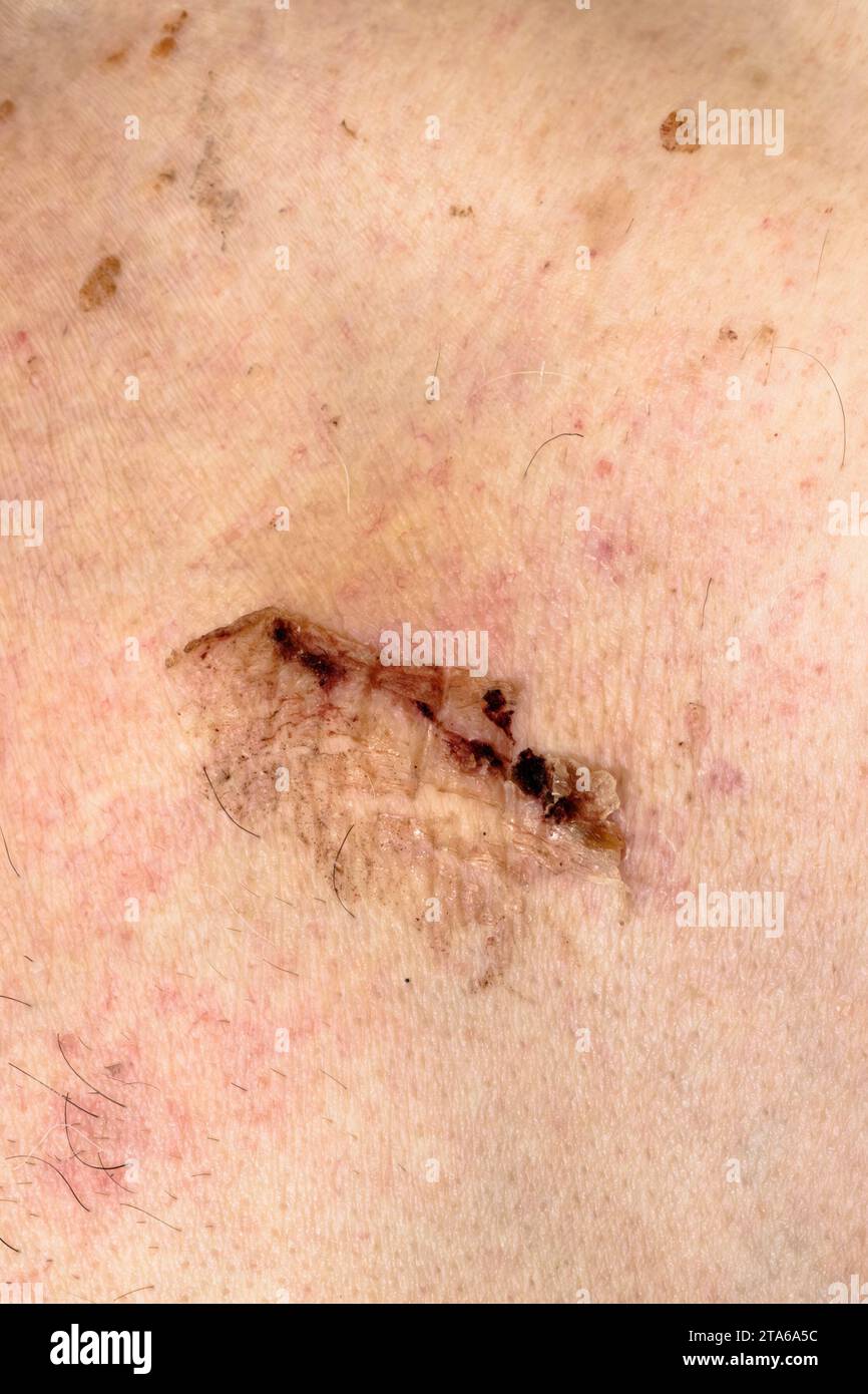 Pacemaker operation scar on chest of a senior man. 3 weeks old. Stock Photo