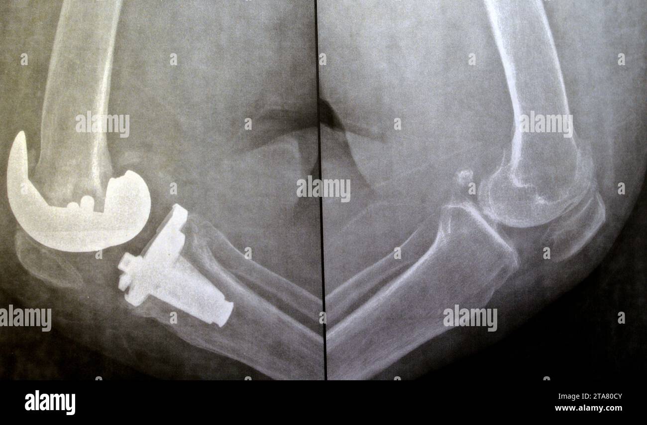Plain X-ray of knee joints, right side shows total knee replacement arthroplasty after joint osteoarthritis grade 4, a surgical procedure to replace t Stock Photo