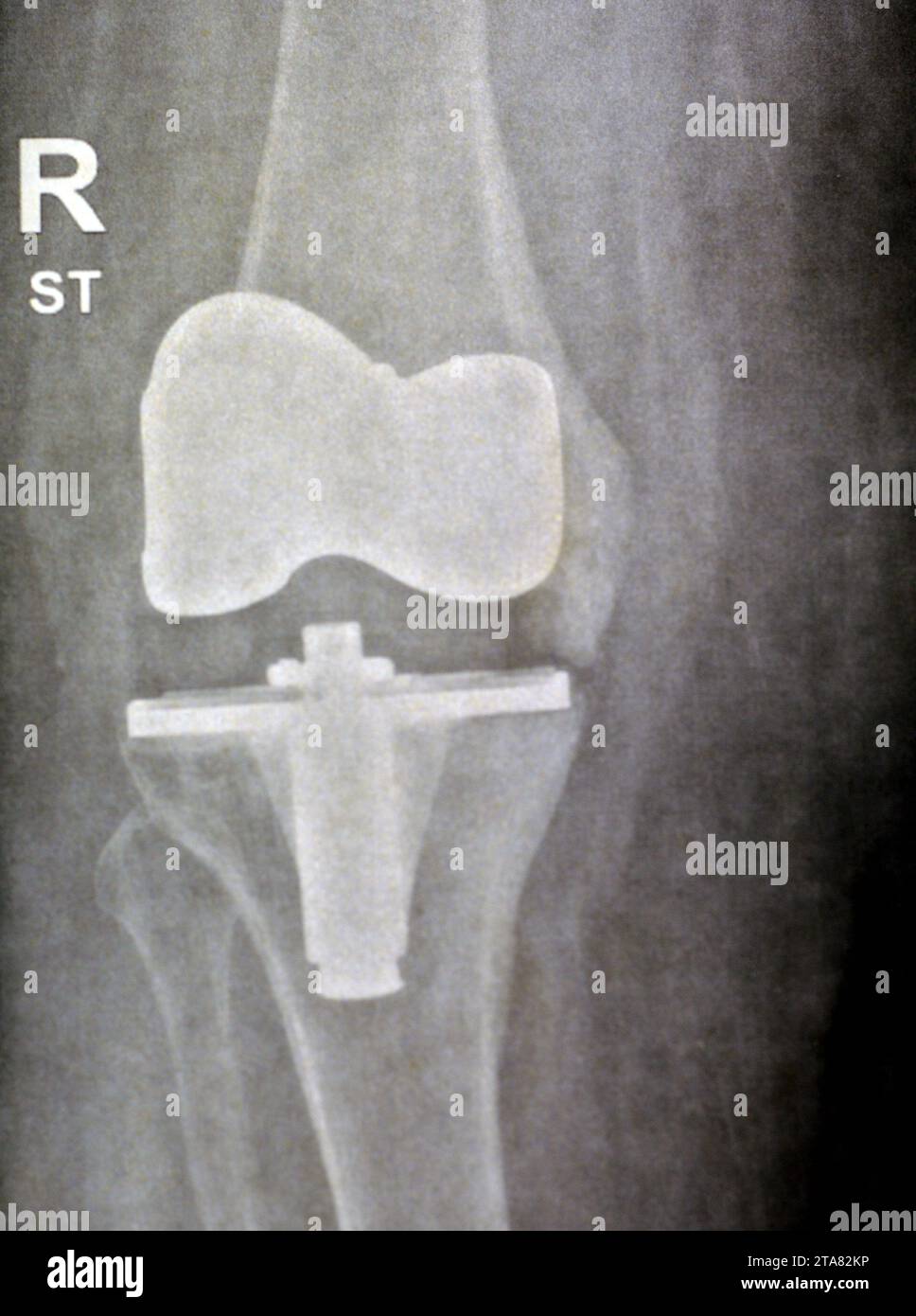 Plain X-ray showing Total right knee replacement arthroplasty after joint osteoarthritis grade 4, a surgical procedure to replace the weight-bearing s Stock Photo