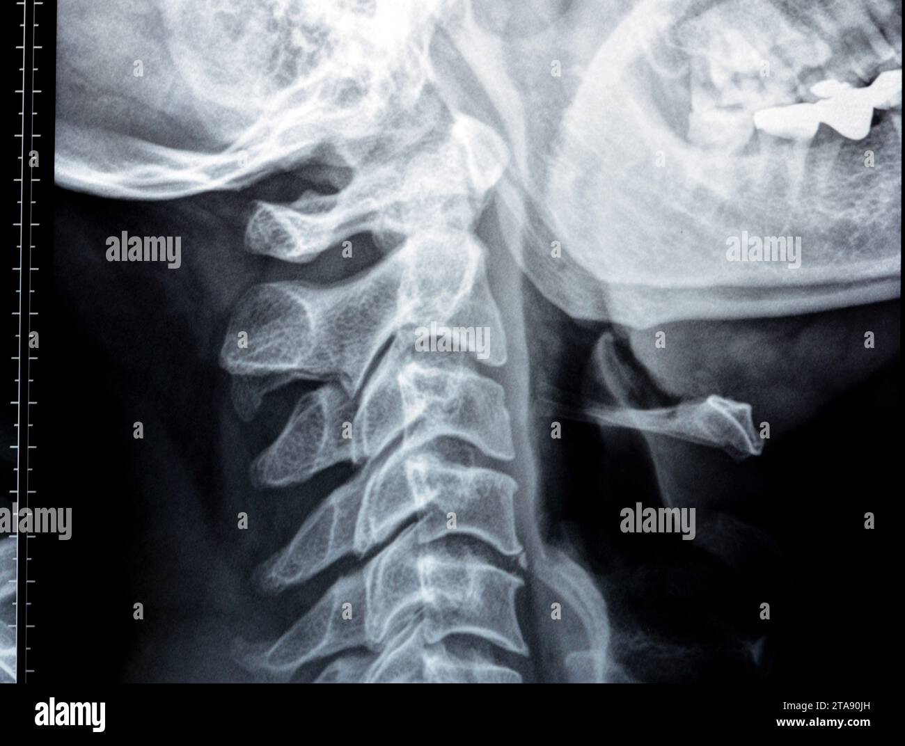 Plain X Ray Of Cervical Spine Revealed Straightened Cervical Curve ...