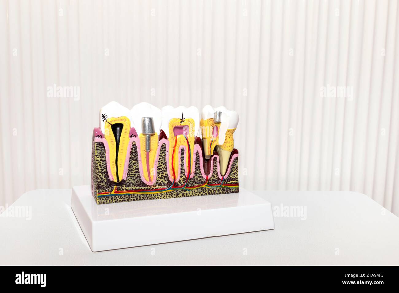 Dental Tooth Implant, Bridge Or Crown Model On White Background in