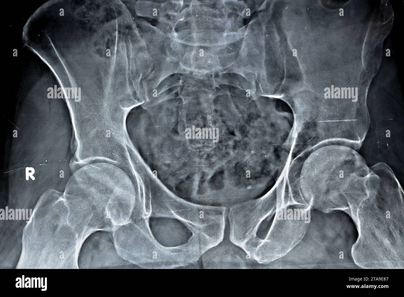 Plain X-ray of both hip joints revealed slight narrowing of superolateral aspect of both hip joints spaces with subchondral sclerosis of the opposed a Stock Photo
