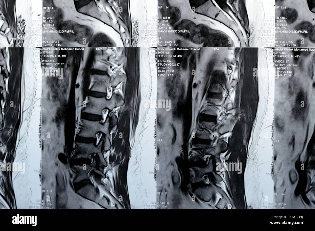 Cairo, Egypt, November 14 2023: MRI of lumbosacral spine revealed L3-L4, L4-L5 posterior disc bulges, effacing ventral epidural fat, indenting the the Stock Photo