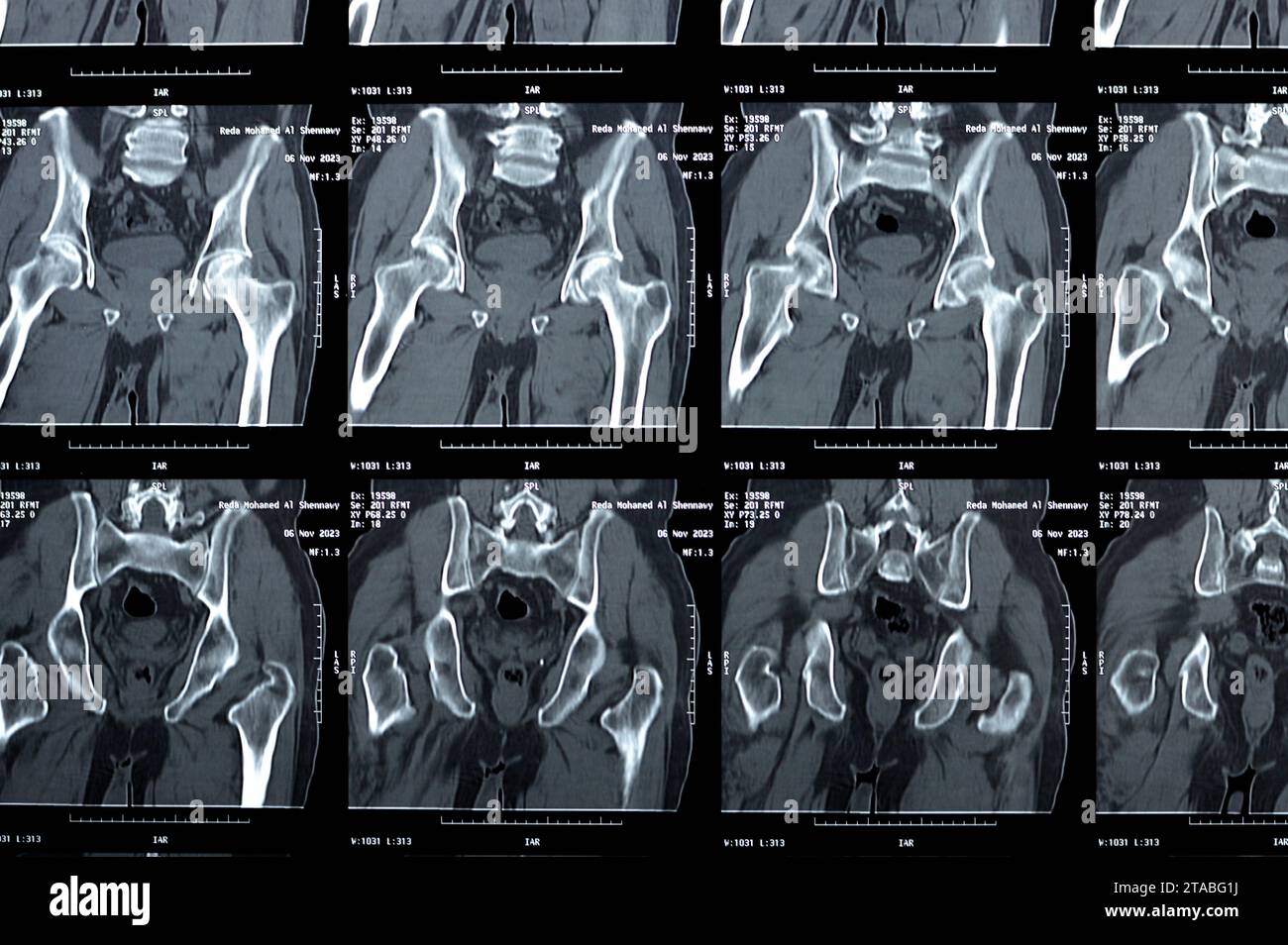 Cairo, Egypt, November 21 2023: non enhanced CT scan of the pelvis revealed grade I anterolisthesis of L4 and L5 lytic degenerative, normal urinary bl Stock Photo