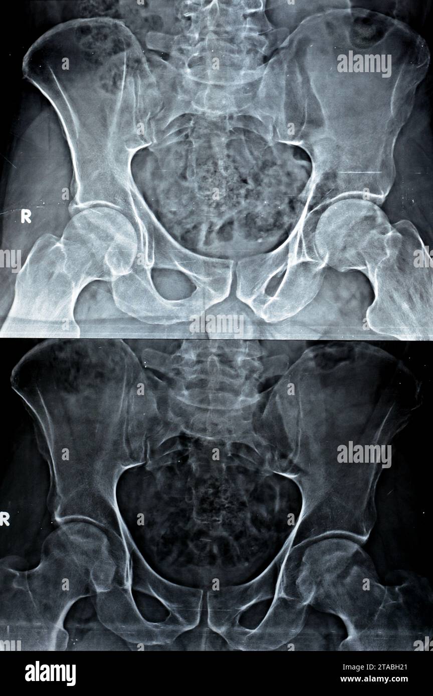 Plain X-ray of both hip joints revealed slight narrowing of superolateral aspect of both hip joints spaces with subchondral sclerosis of the opposed a Stock Photo