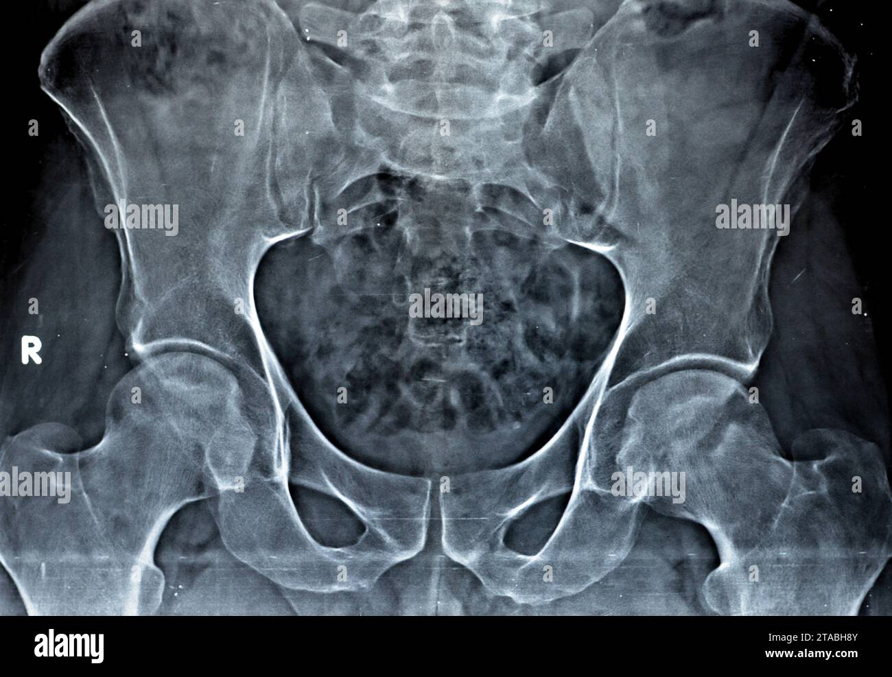 Plain X-ray of both hip joints revealed slight narrowing of ...