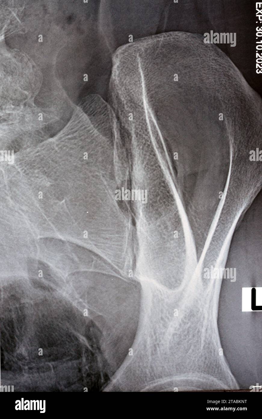 Sacroiliac joint digital radiograph examination Xray reveals preserved