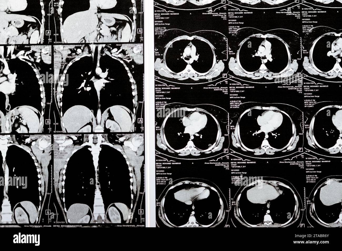 Cairo, Egypt, October 15 2023: CT scan axial slices through chest with contrast injection showing low grade of inflammatory reaction, parenchymal vess Stock Photo