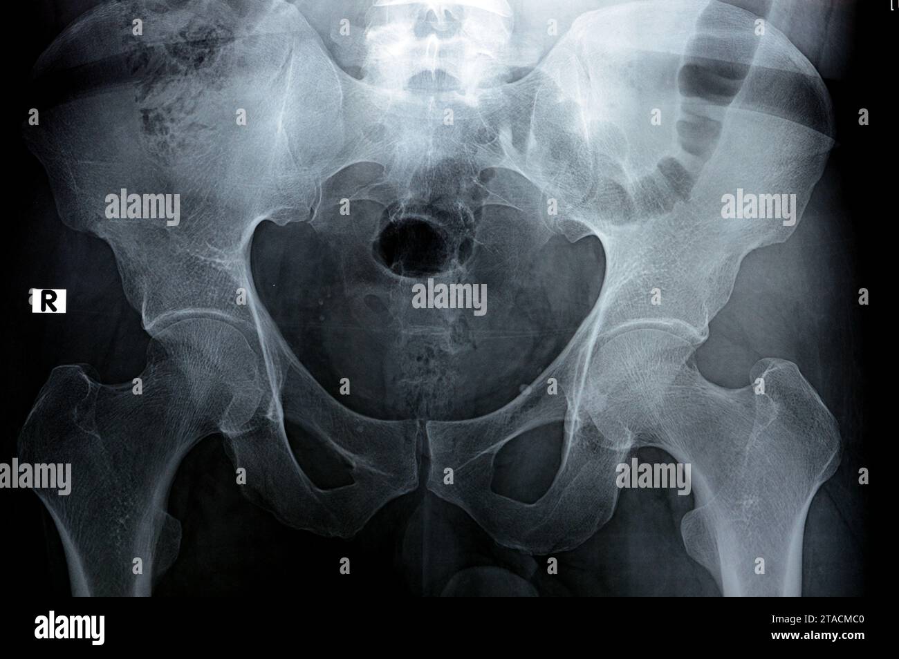 Hip joints digital radiographic examination reveals normal appearance of hip joins, multiple pelvic phleboli, bilateral coxa profunda, preserved spher Stock Photo