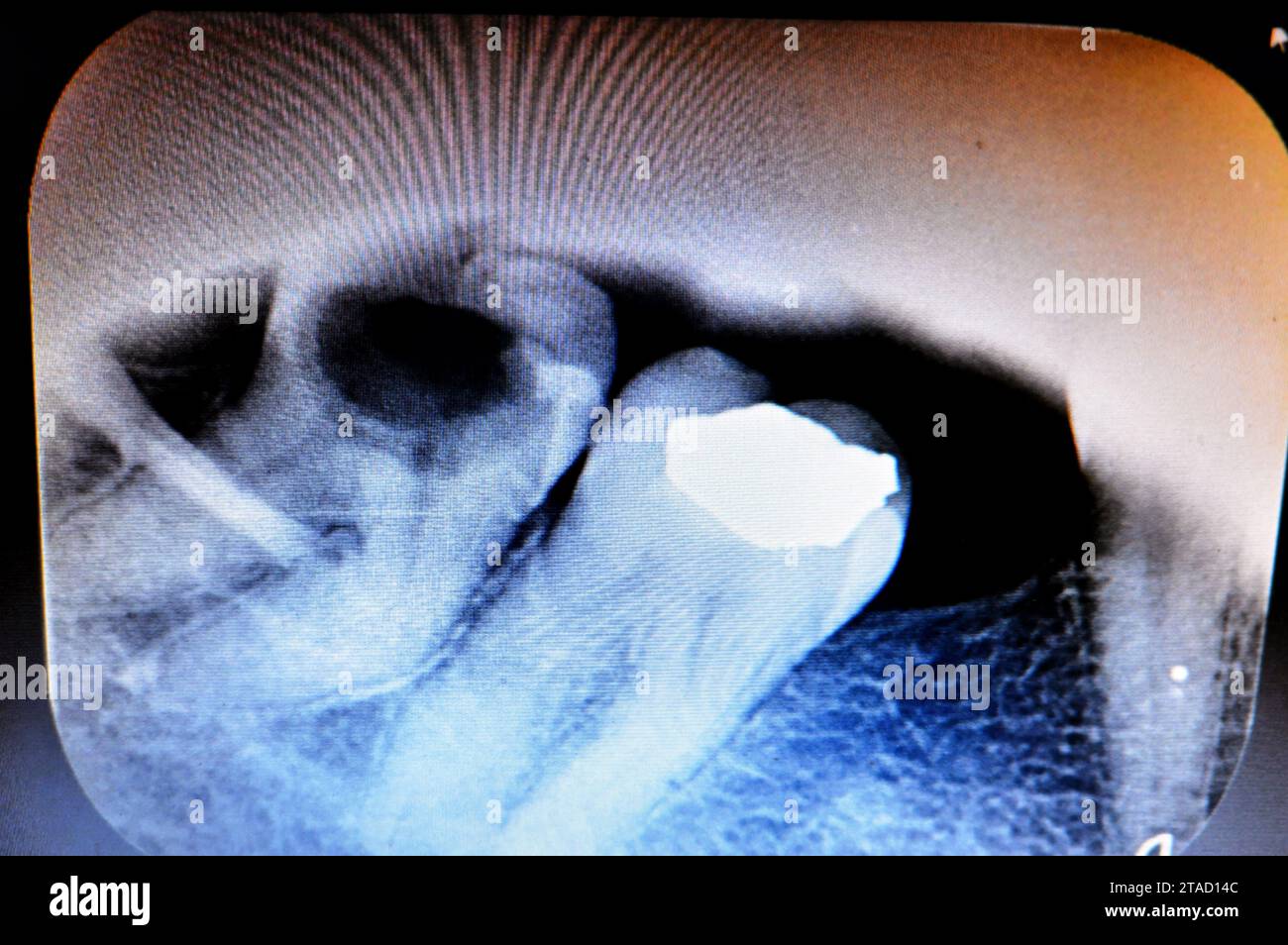 X ray on wisdom 8th lower right tooth with a teeth decay, after exposed nerve and severe pain, swelling and inflammation, Wisdom teeth are the molars Stock Photo
