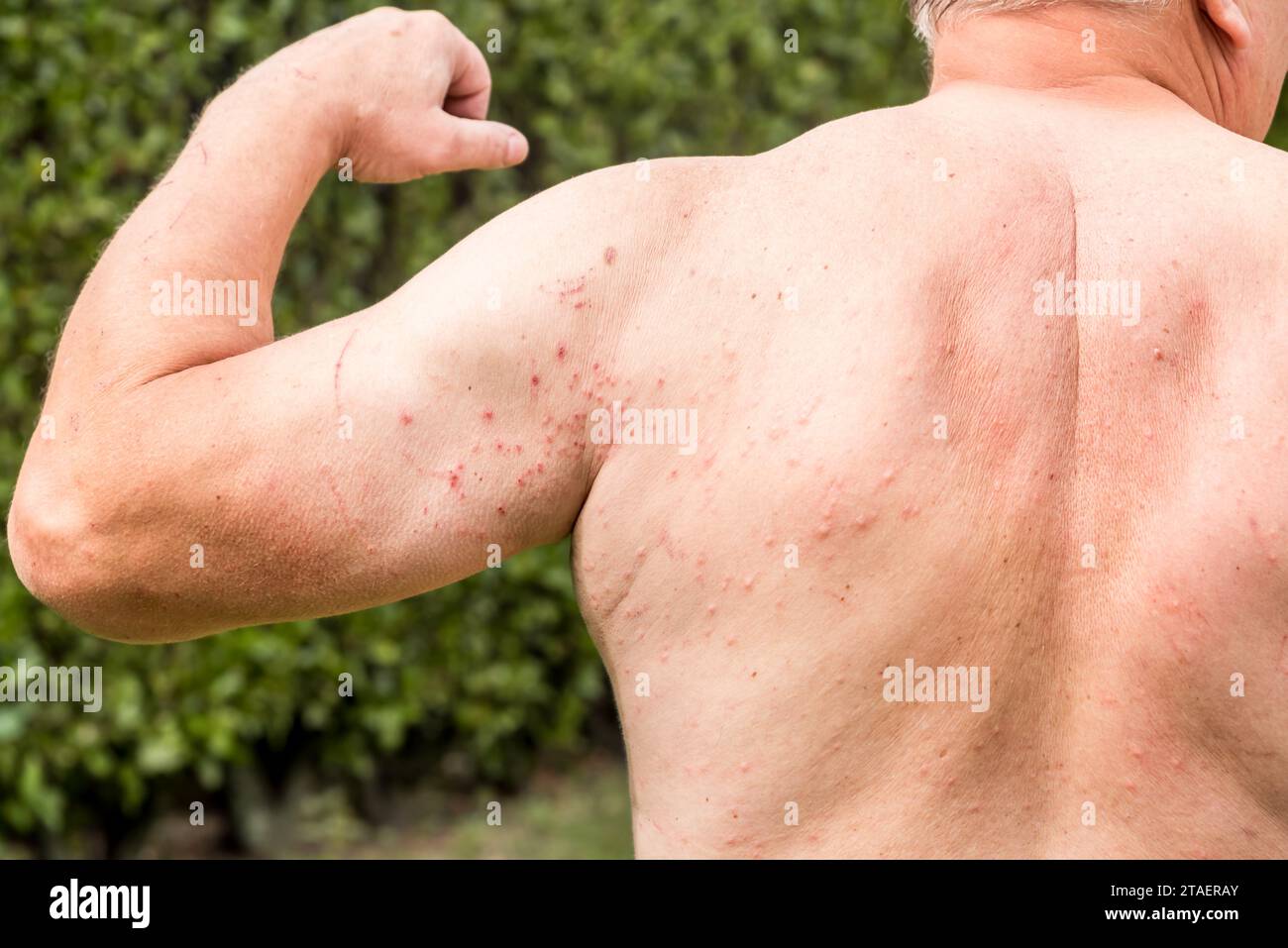 Back and arms of man with rash on, symptoms of itching, skin allergy Stock Photo Alamy