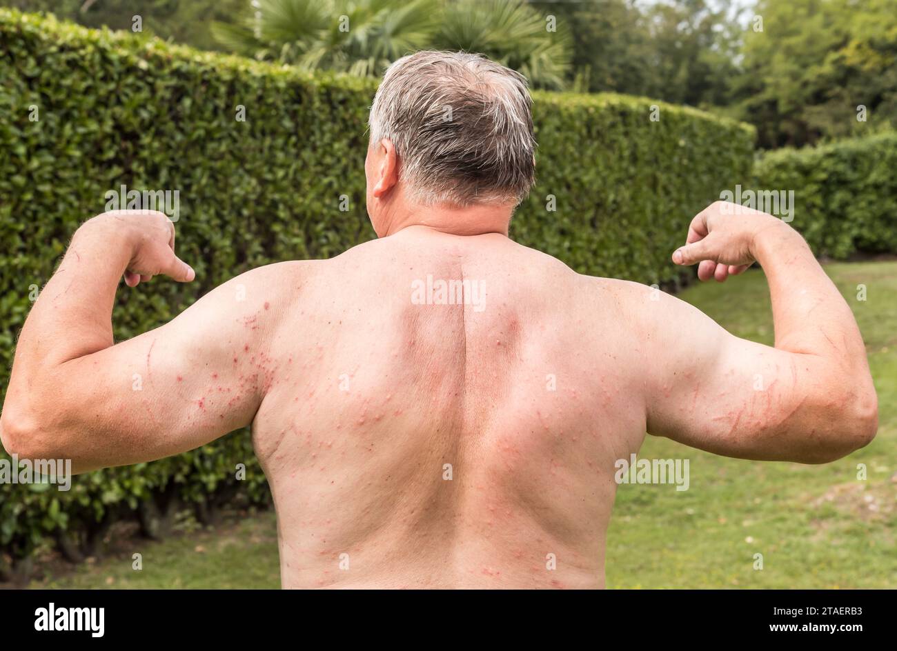 Back and arms of man with rash on, symptoms of itching, skin allergy