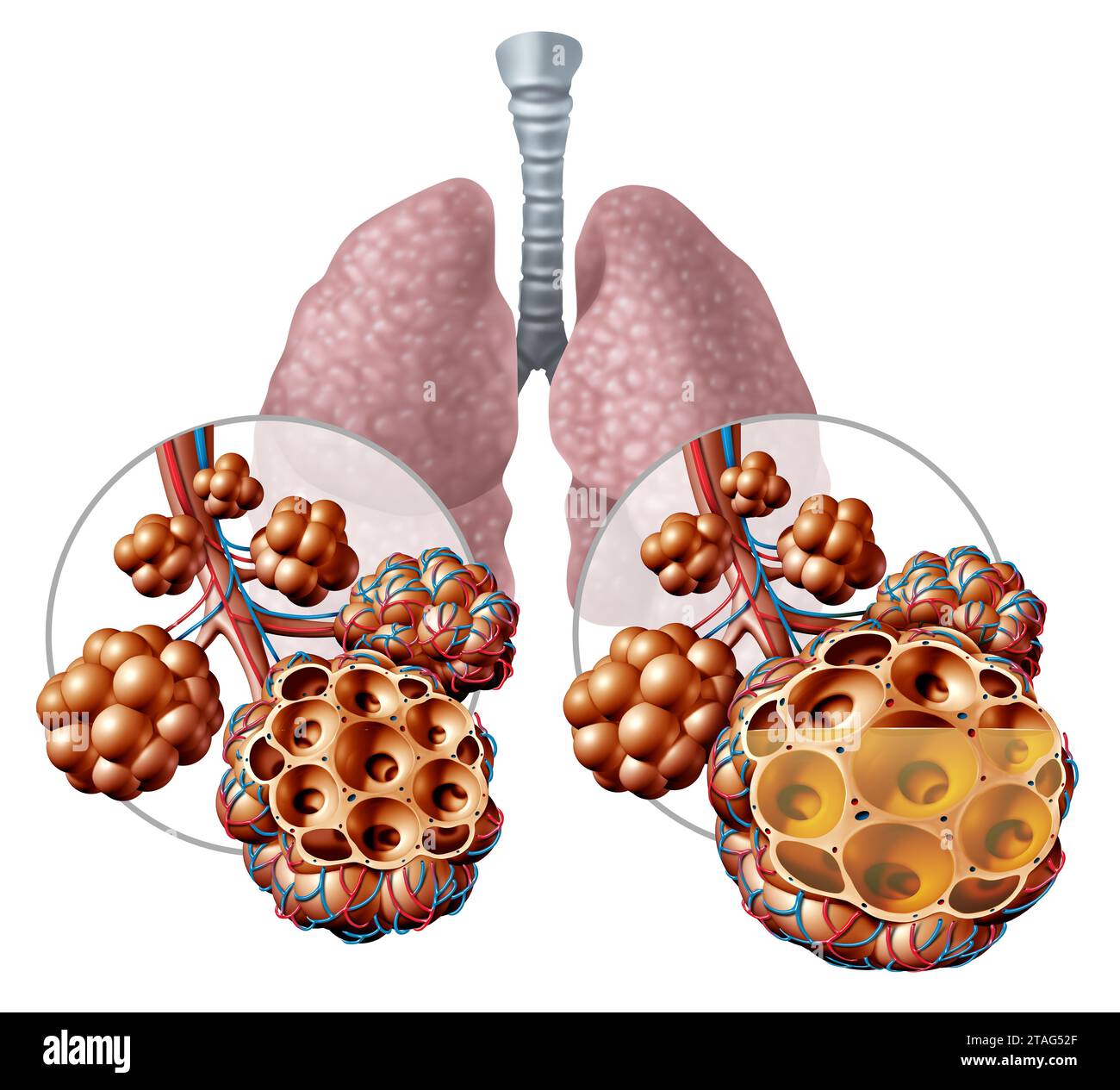 Pneumonia In the Lungs and Pulmonary alveoli with fluid or alveolus inflammation anatomy diagram as a medical concept of a lung anatomy Stock Photo