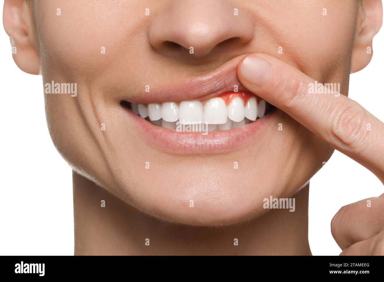 Woman showing inflamed gum on white background, closeup Stock Photo