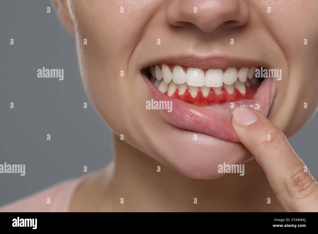 Woman showing inflamed gum on grey background, closeup Stock Photo