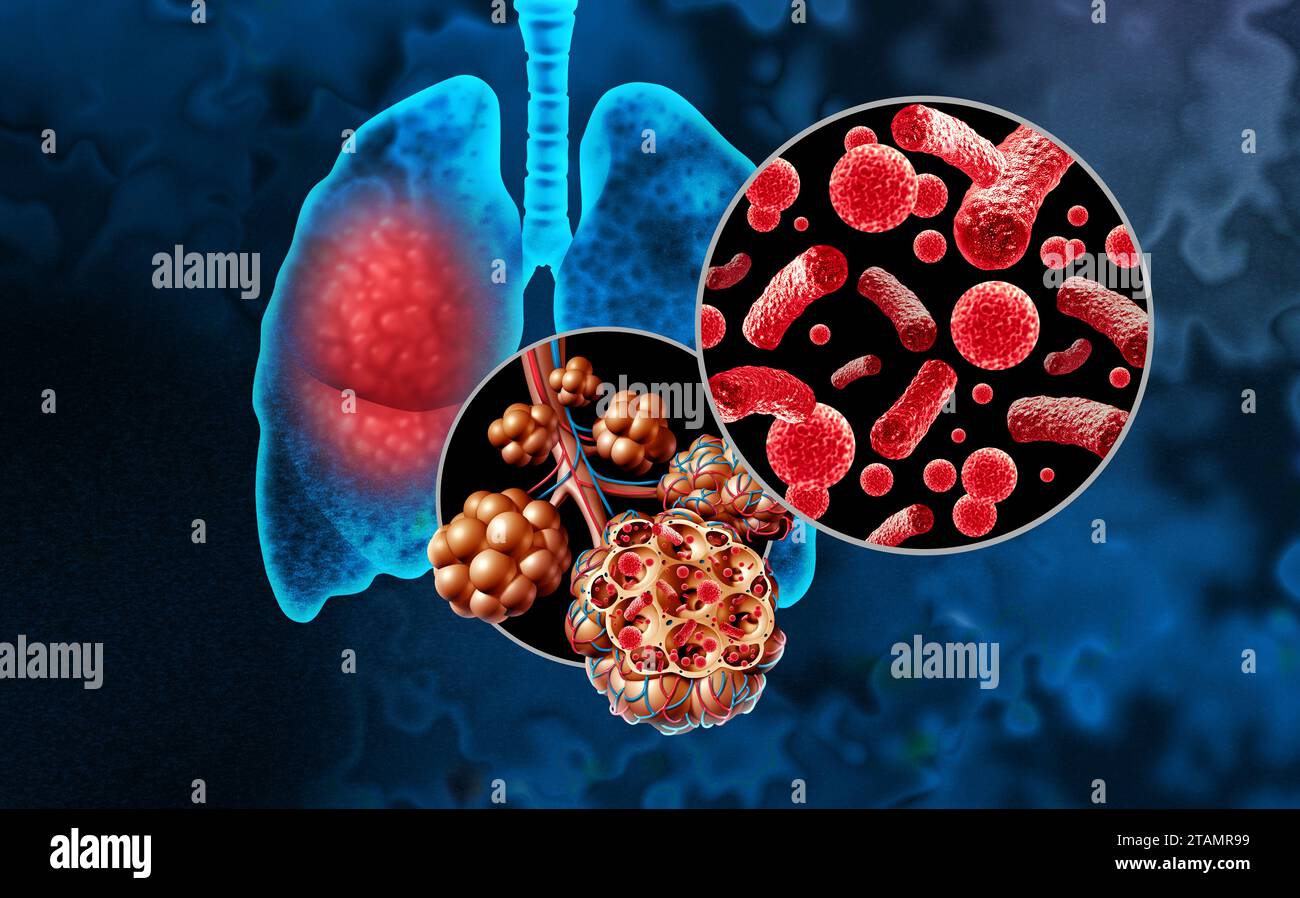 Bacterial Pneumonia or Pneumonia In the Lungs and Pulmonary alveoli