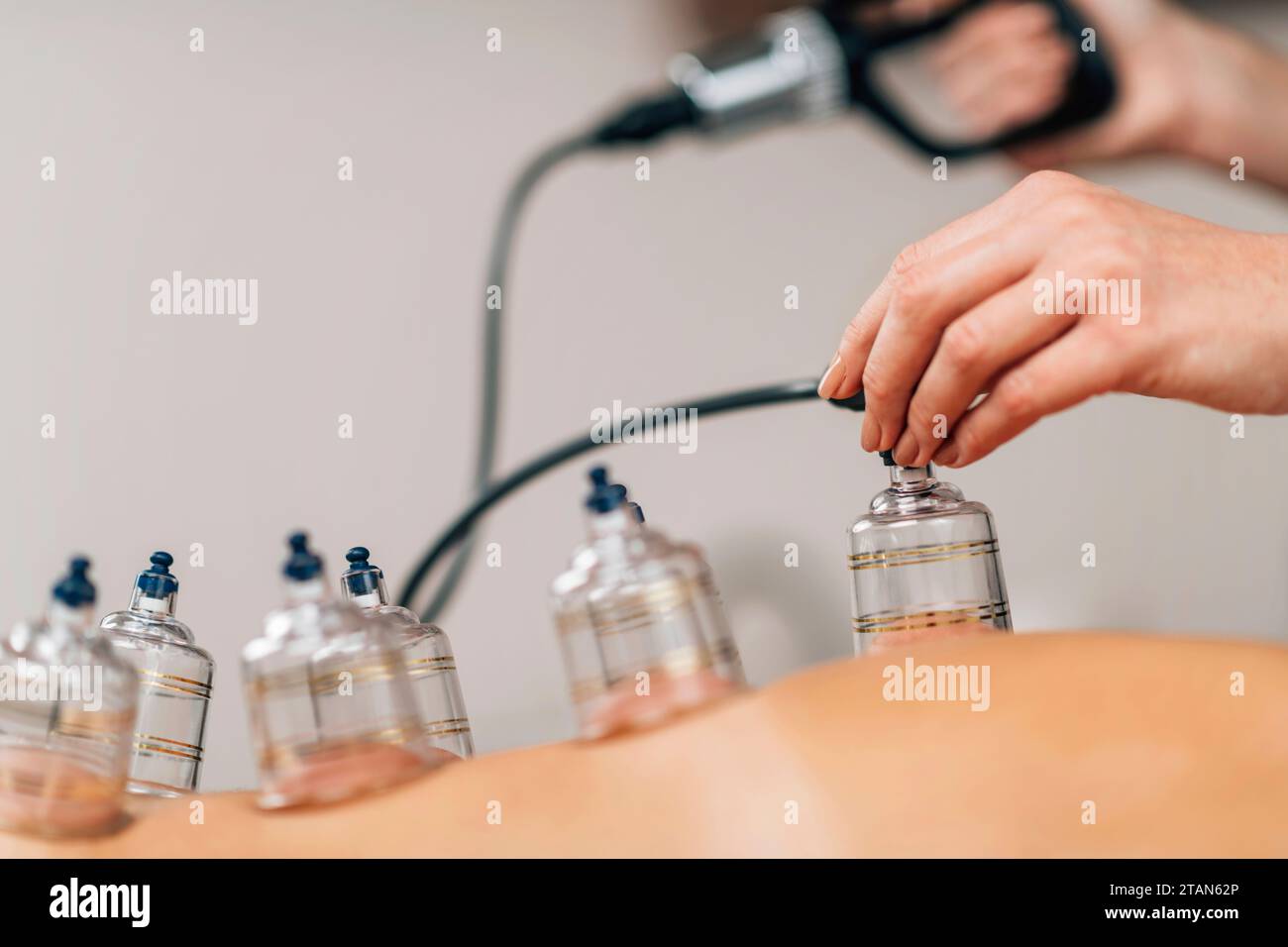 Cupping therapy Stock Photo