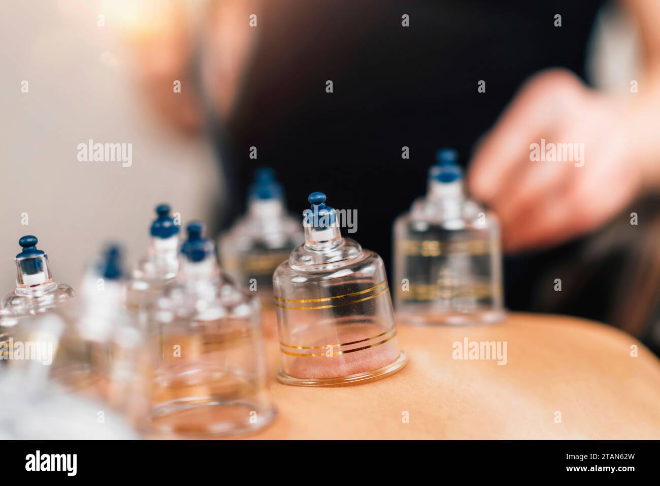 Cupping therapy Stock Photo