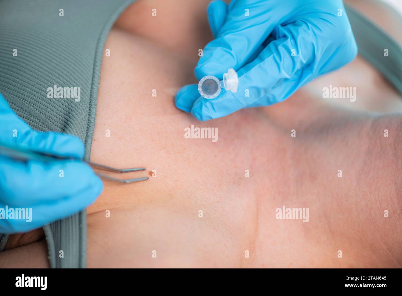 Cutaneous Sample Dermatologist taking skin sample Stock Photo - Alamy