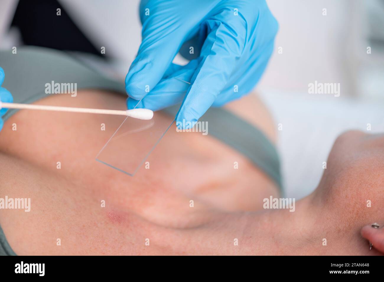 Dermatologist taking skin sample Stock Photo