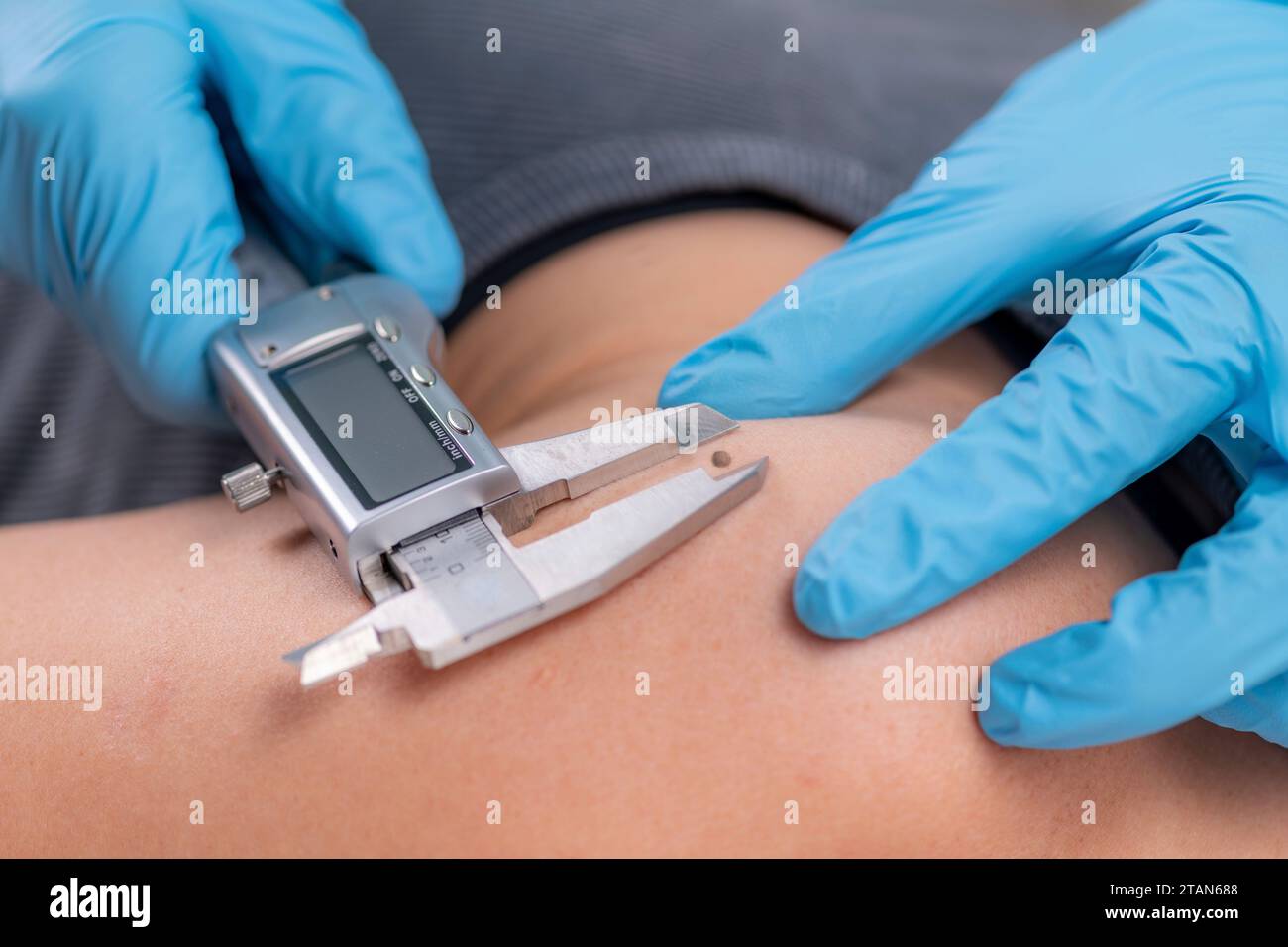 Dermatologist measuring mole Stock Photo