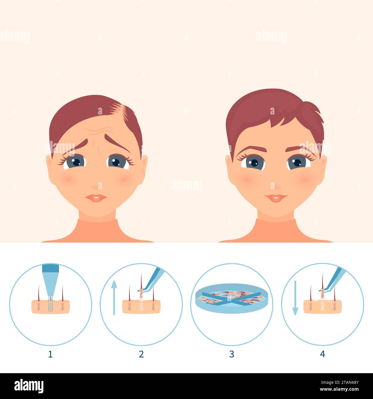 FUE hair transplantation, conceptual illustration Stock Photo