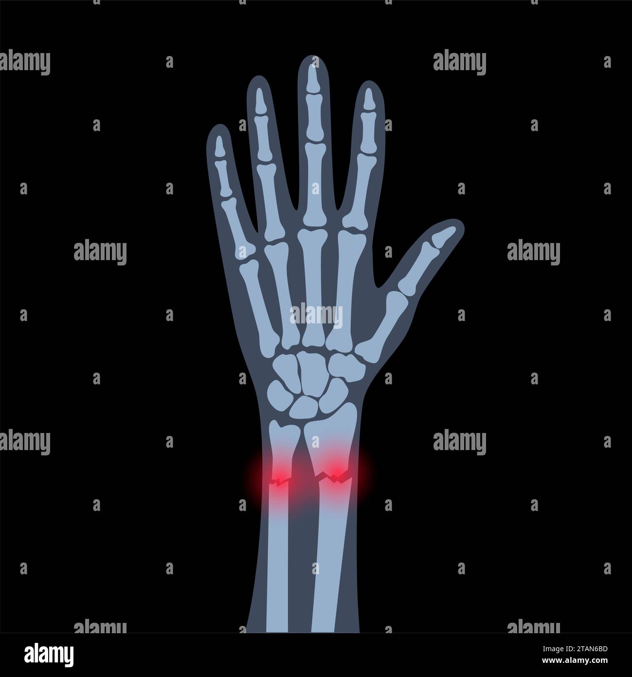 Fractured wrist, illustration Stock Photo