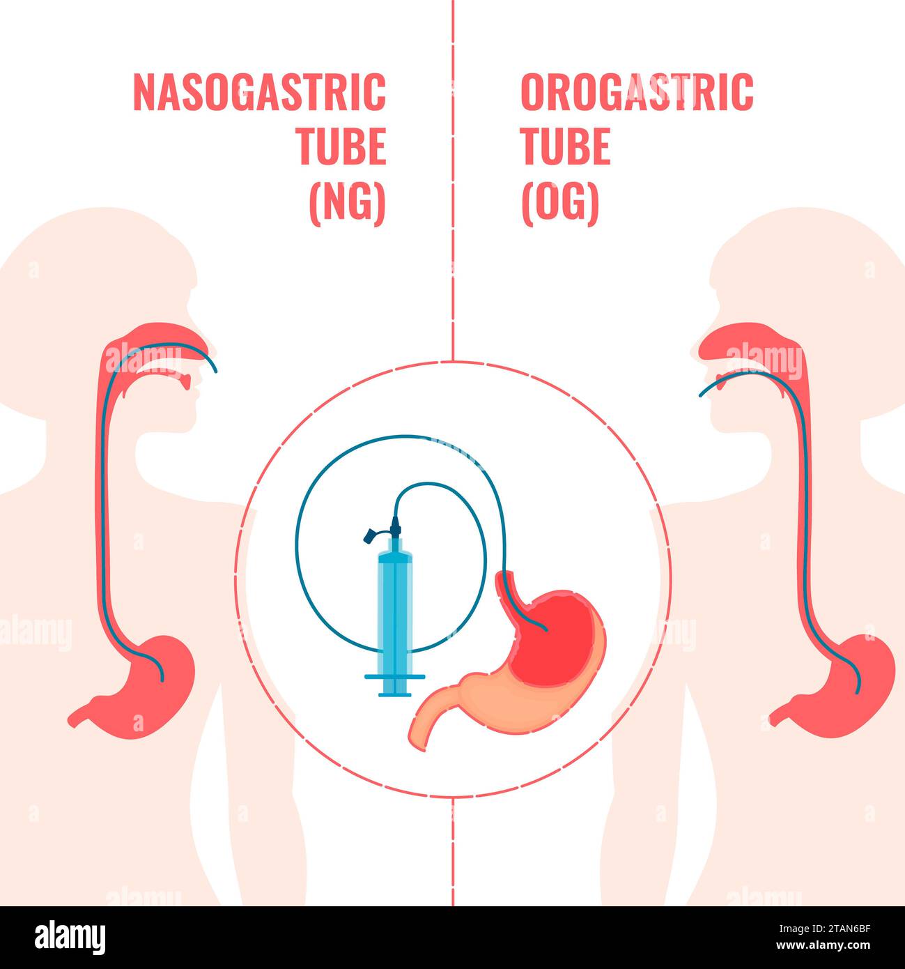 Enteral feeding tubes, conceptual illustration Stock Photo Alamy