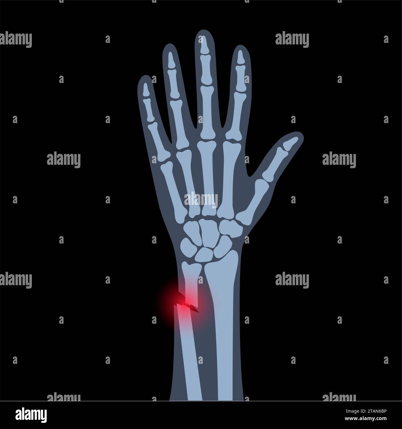 Fractured wrist, illustration Stock Photo