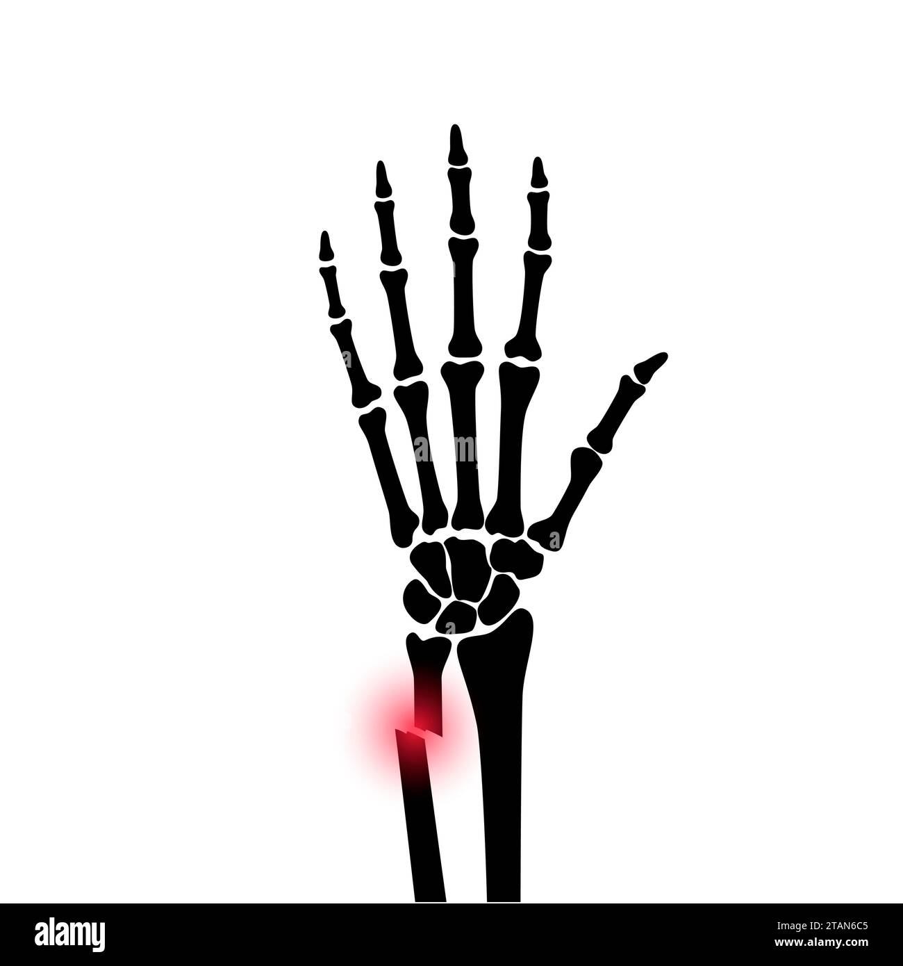 Fractured wrist, illustration Stock Photo