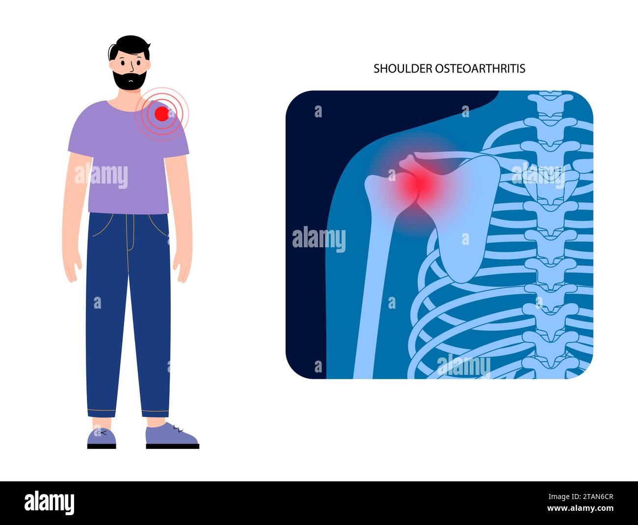 Shoulder pain and arthritis, conceptual illustration Stock Photo Alamy