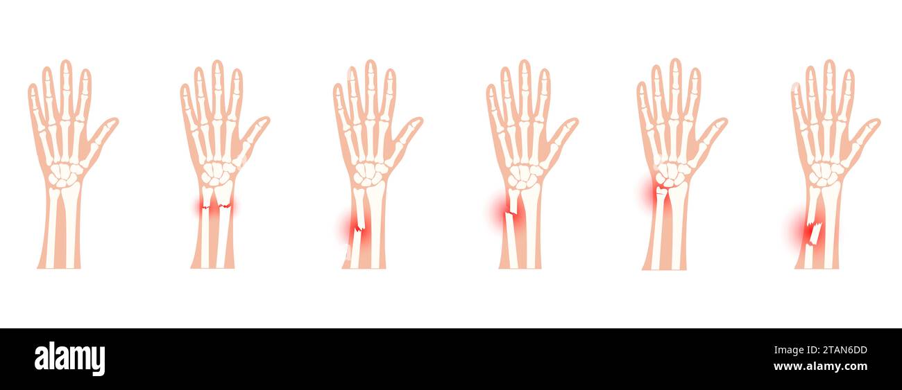 Fractured wrists, illustration Stock Photo Alamy
