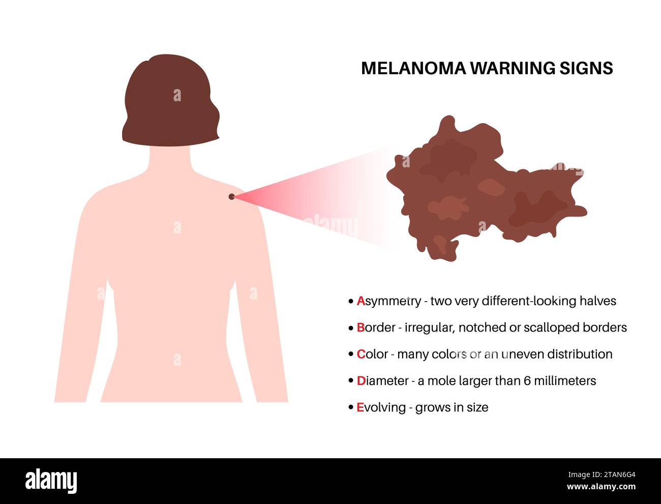 melanoma-warning-signs-illustration-stock-photo-alamy