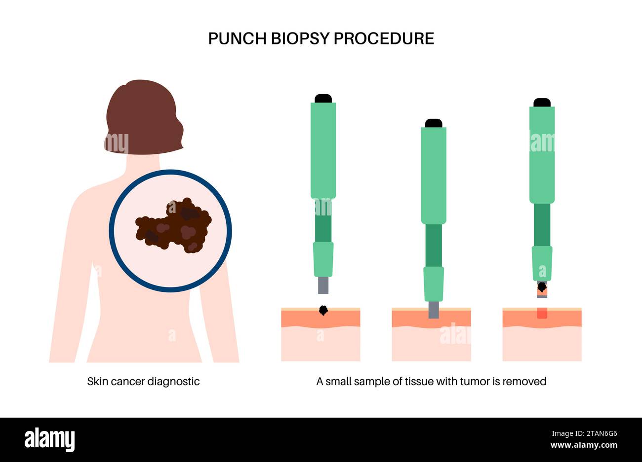 Punch biopsy, illustration Stock Photo Alamy