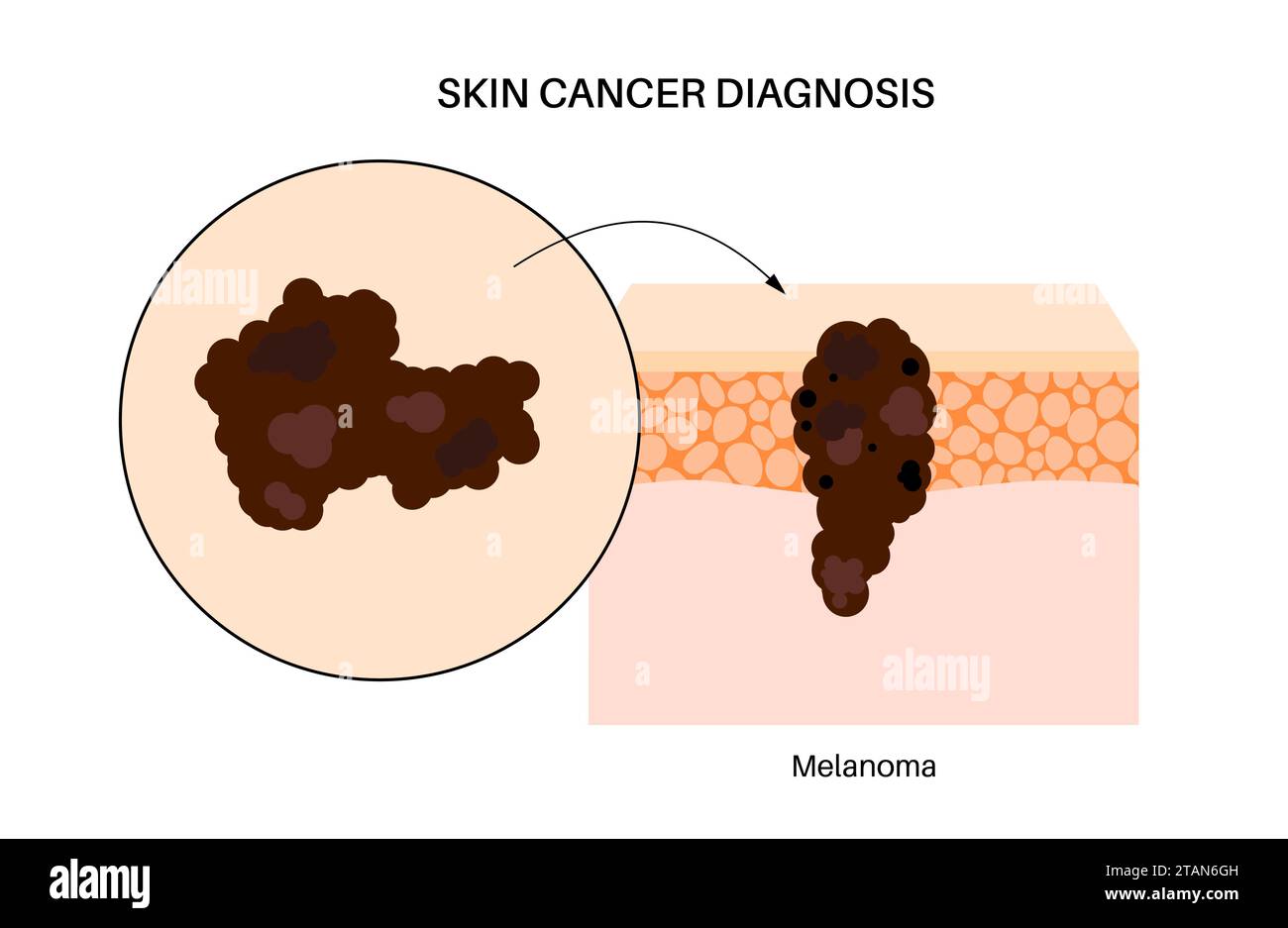 Skin cancer, illustration Stock Photo - Alamy