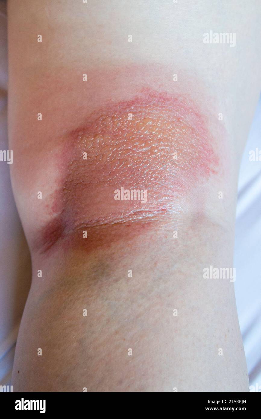 sample of atopic dermatitis - eczema dermatitis behind knee closeup Stock Photo