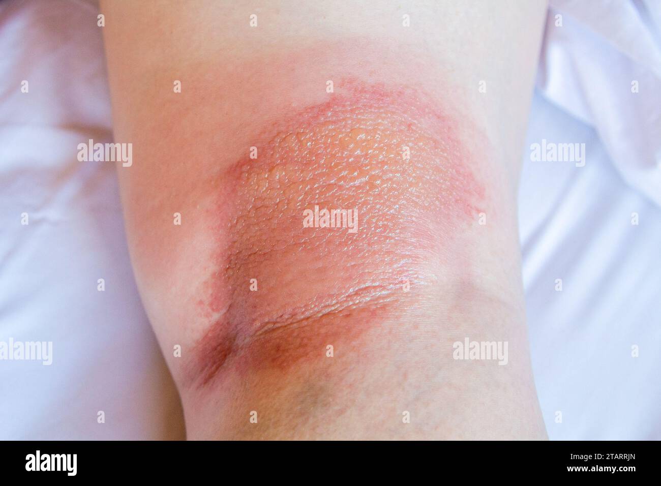 sample of atopic dermatitis - eczema dermatitis under knee close up Stock Photo