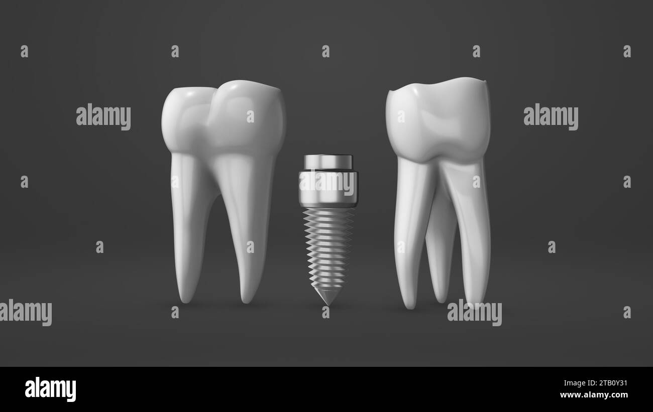 Tooth implant and crown installation process Stock Photo Alamy