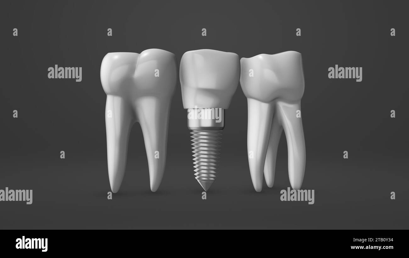 Tooth implant and crown installation process Stock Photo Alamy