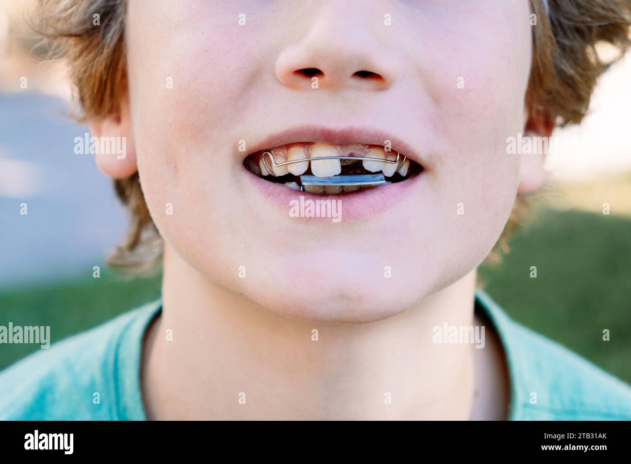 Boy getting an orthodontic appliance to correct jaw misalignment Stock