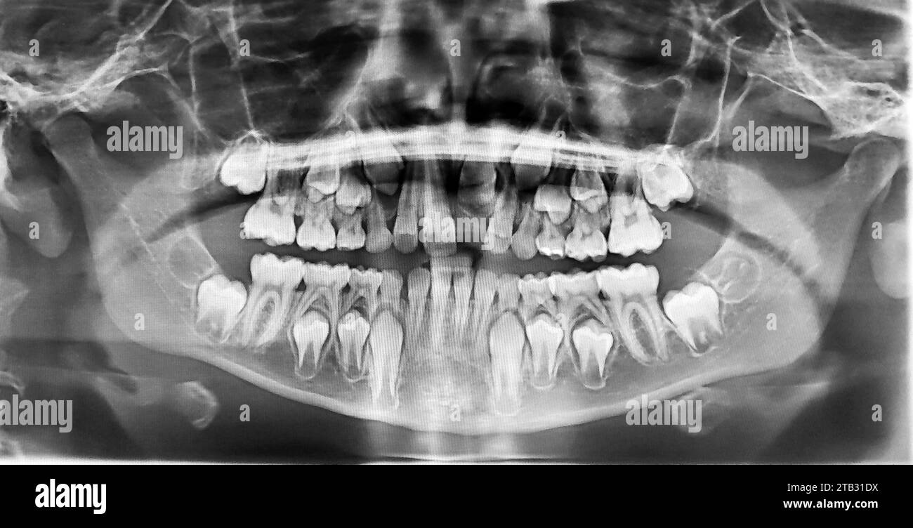 Real capture of an xray of the teeth of a 10yearold child Stock