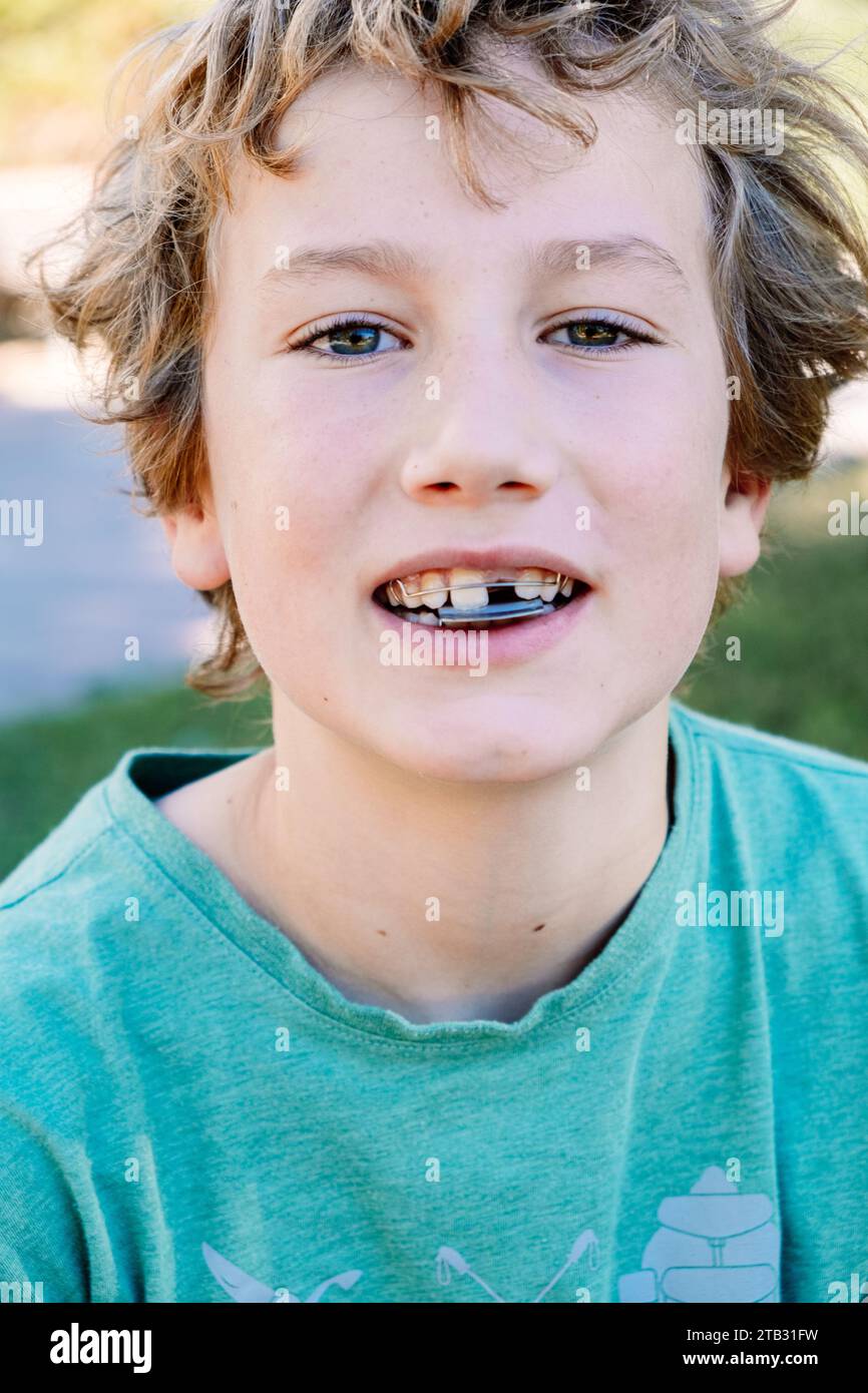 Boy getting an orthodontic appliance to correct jaw misalignment Stock