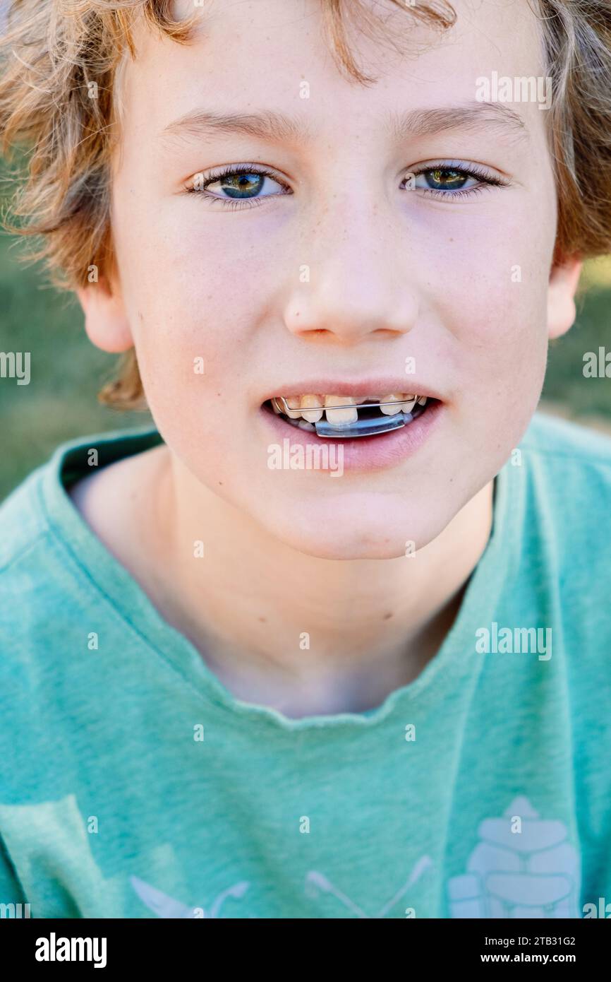 Child with orthodontic appliance to correct malocclusion, forward bite