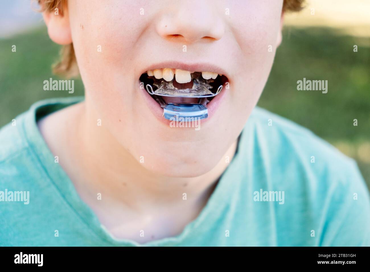 Child with orthodontic appliance to correct malocclusion, forward bite