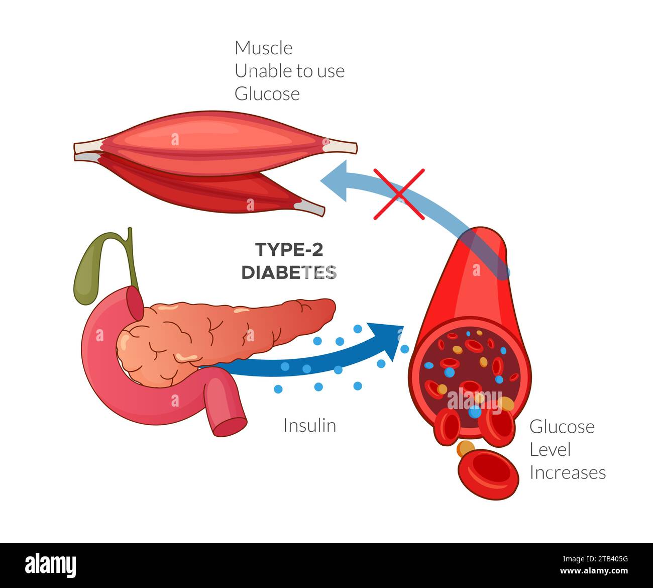 Type 2 Diabetes - Insulin Resistance - Stock Illustration as EPS 10 File Stock Vector
