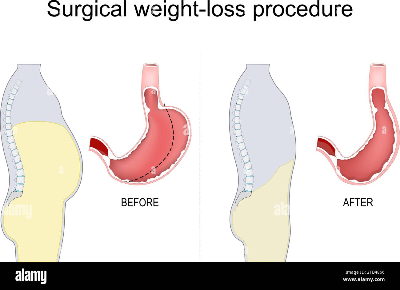 Vertical sleeve gastrectomy. Stomach reduction. Surgical procedure