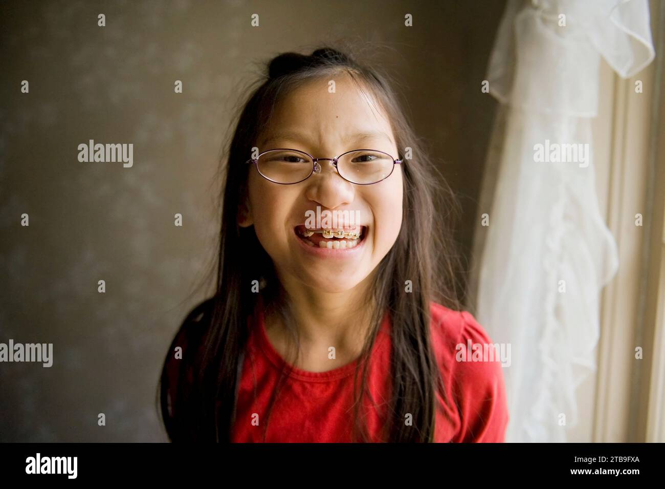 Portrait of a girl with repaired cleft lip and braces smiles big for the camera; Lincoln, Nebraska, United States of America Stock Photo