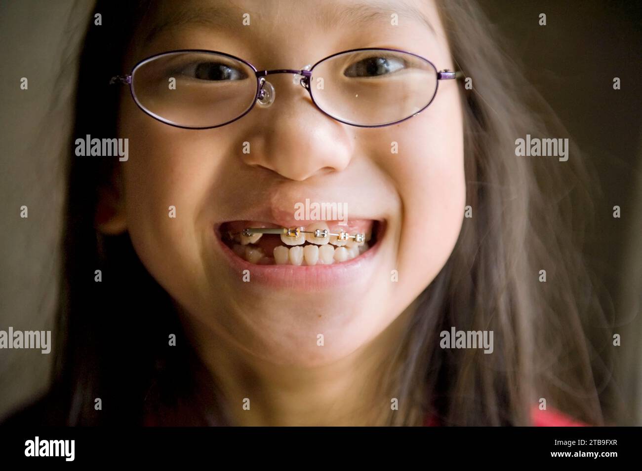Close-up portrait of a girl with repaired cleft lip and braces smiles big for the camera; Lincoln, Nebraska, United States of America Stock Photo
