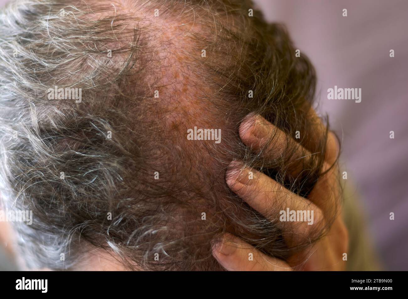 Close up of hand touching scalp with hair loss problem. 30 year old caucasian man with very thin hair worried about hair loss. Stock Photo