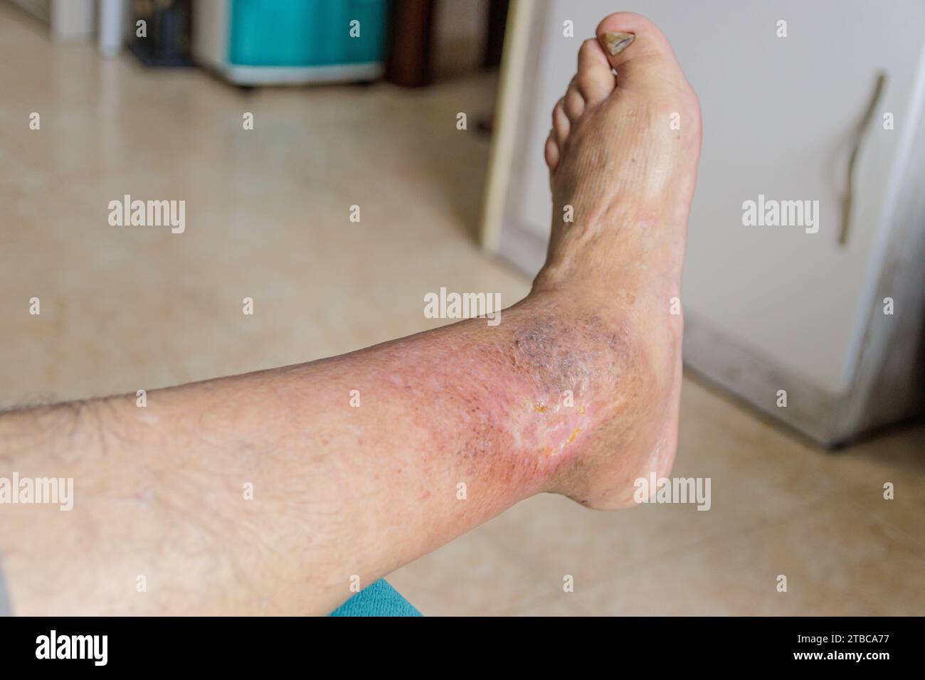 Leg senior person with ulcer due to diabetes Stock Photo
